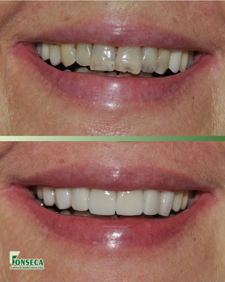 Antes e depois de 2 coroas e 5 facetas laminadas em sistema Emax