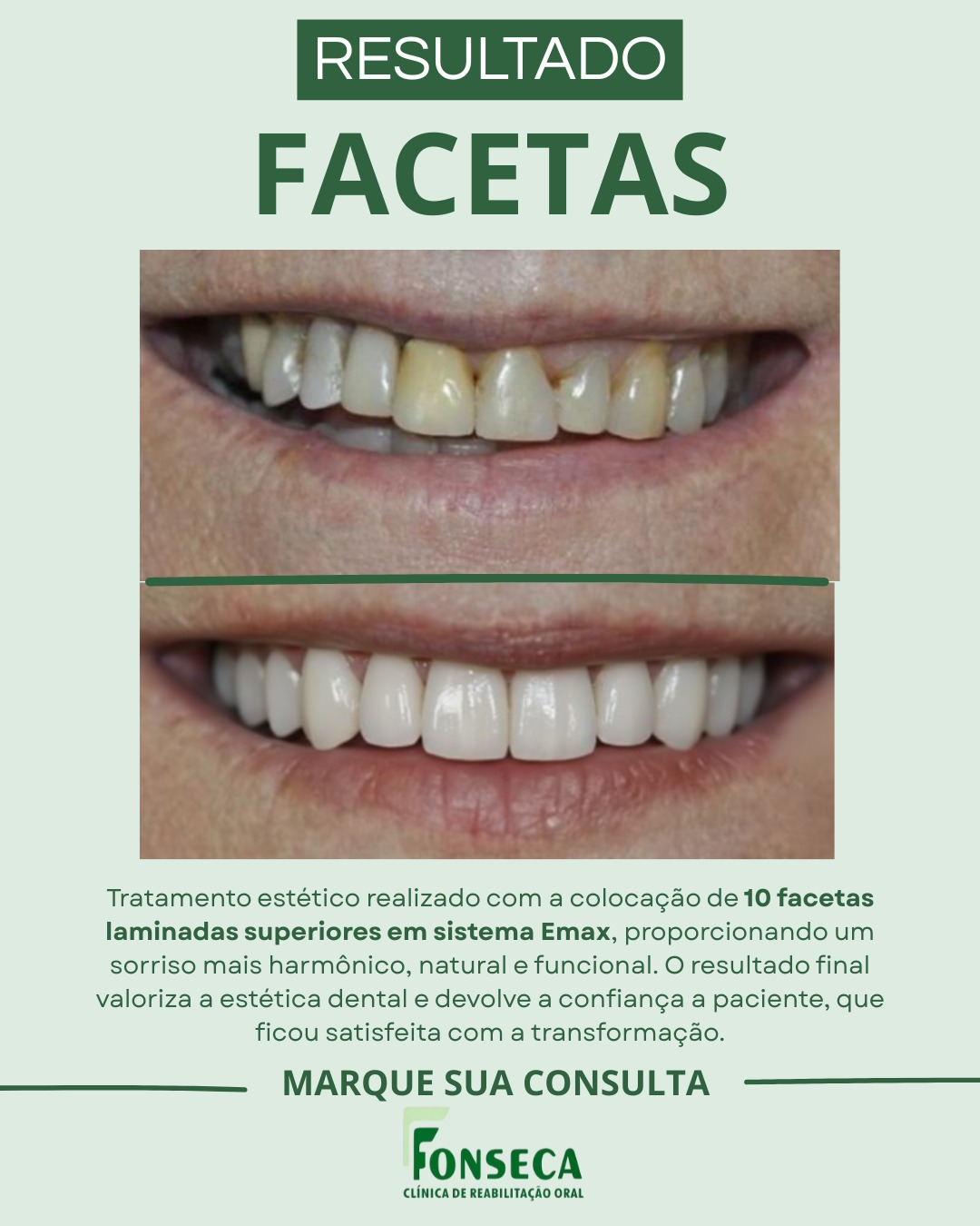 Resultado de facetas laminadas: antes e depois do sorriso da paciente